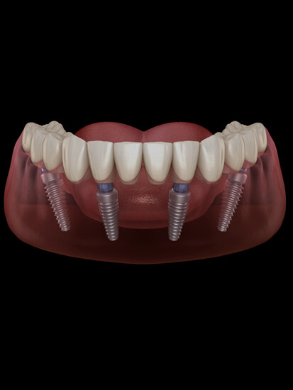 Dental Implants in Sidcup  1