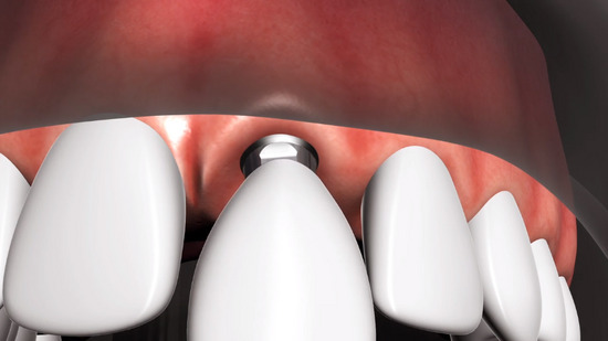 Dental Implants in Sidcup  2
