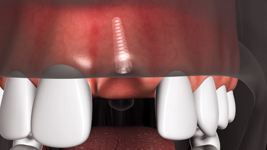 Dental Implants in Sidcup  3