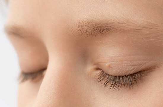 Understanding Eyelid Tags: A Brief Overview by London Dermatology Clinics  0