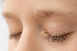 Understanding Eyelid Tags: A Brief Overview by London Dermatology Clinics